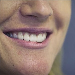 Tecnica di ortodonzia invisibile a Pordenone