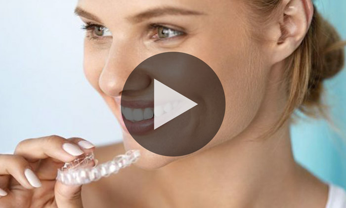 Caso clinico Invisalign